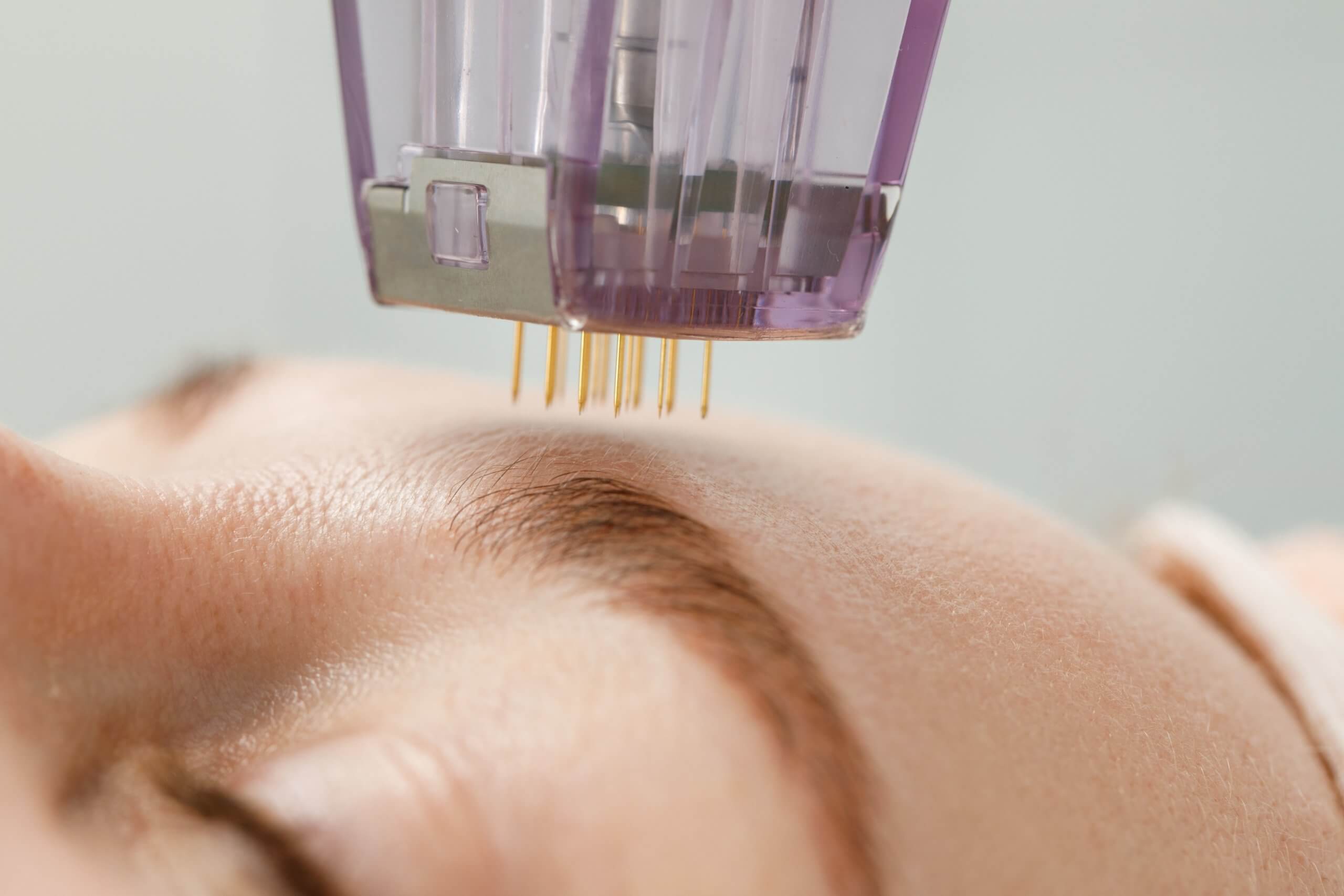 What is Microneedling and Its Benefits